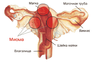 Миома матки